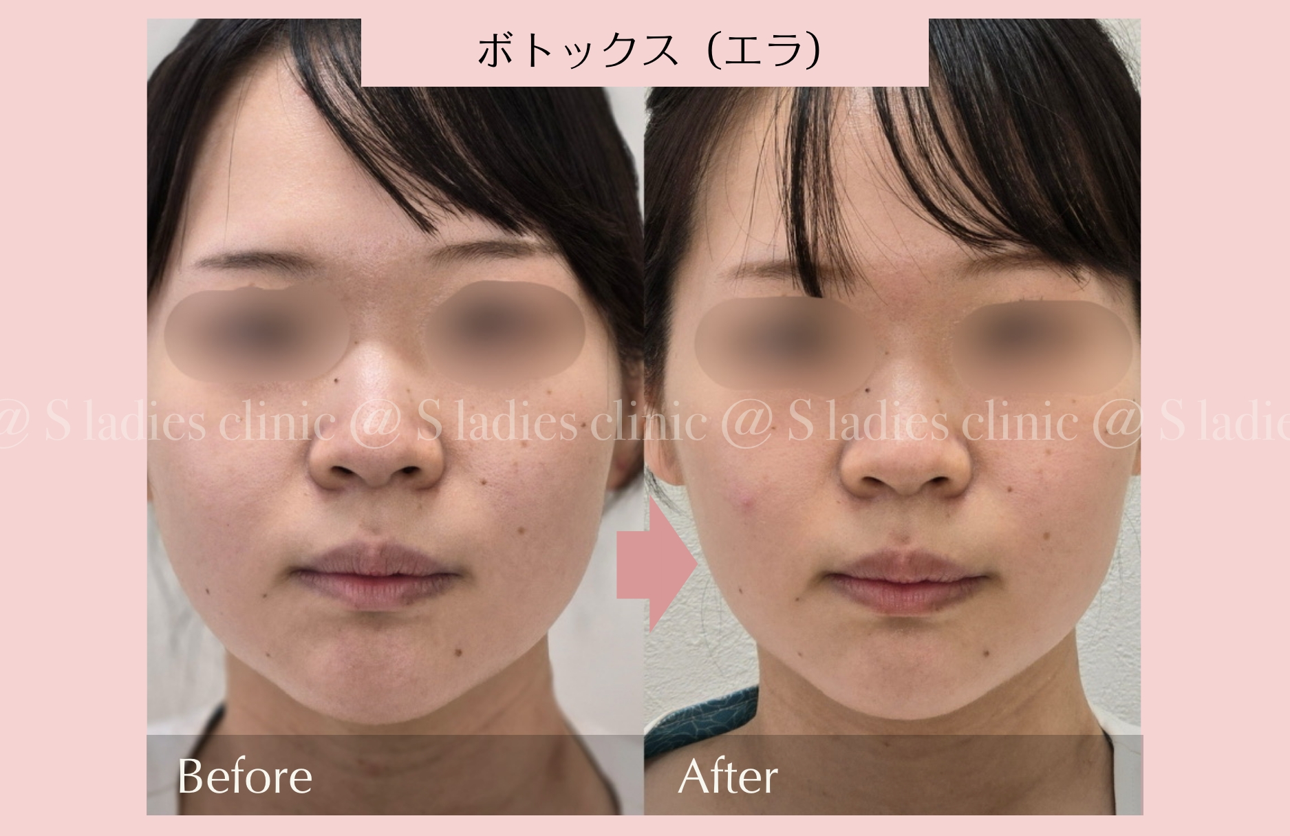 ボトックス(エラ)ビフォー・アフター