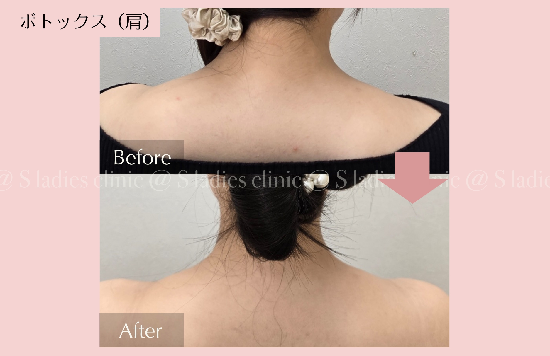 ボトックス(肩)ビフォー・アフター